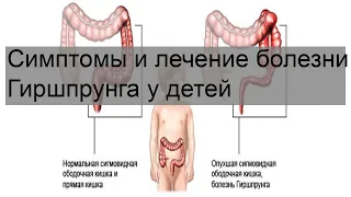 Симптомы и лечение болезни Гиршпрунга у детей