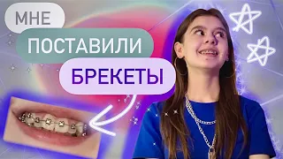 О том, как мне поставили брекеты // Первые ощущения после установки