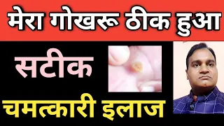 मेरा गोखरू ( corn ) ठीक हो गया // चमत्कारी दवा के बारे में जाने // Corn ka ilaj jisse mera thik hua