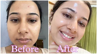 Dermatologist recommended Best 2 Cream under Rs 300 that has changed my skin | Best pharmacy cream