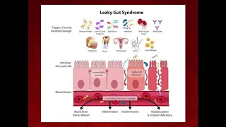 How Leaky Gut Causes Autoimmune Disease