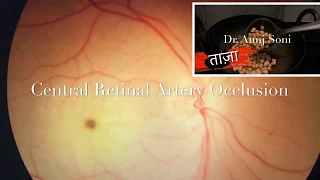Central Retinal Artery Occlusion