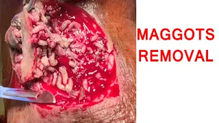 Maggots Removal | Diabetic Foot Case Before After