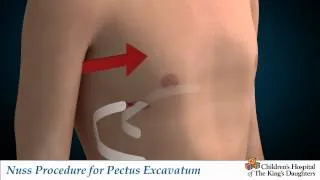 Nuss Procedure for Pectus Excavatum