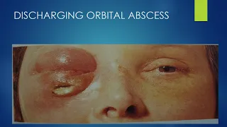 Orbital Inflammatory Diseases