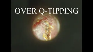 OVER Q-TIPPING, sometimes it creates problems!!