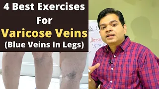 Varicose Veins Exercise, Blue Veins in Legs, Spider Veins Exercise, Varicose Veins Treatment At Home