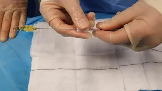 How to deliver a MicroCoil for coronary artery perforation