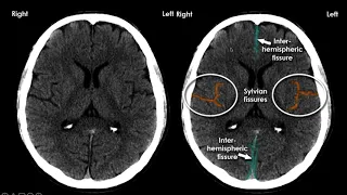 Neuroanatomia Básica na Tomografia de Crânio