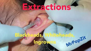 Extractions! Blackheads, whiteheads, ingrown hairs. This one has it all. Ear blackheads. MrPopZit