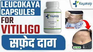 सफेद दाग की सबसे अच्छी दवा कौन सी है? Leucokaya Capsules For #Vitiligo | Best Medicine for Vitiligo