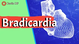 O que é BRADICARDIA? Sintomas de bradicardia e tratamentos (bradicardia sinusal)