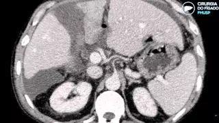 Associating liver partition and portal vein ligation for staged hepatectomy (ALPPS)