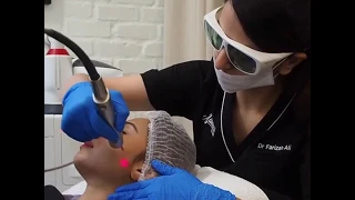 Fotona Laser (Non-Invasive Facelift Treatment)