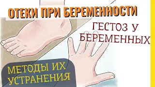 Причины появления отеков при беременности и способы устранения отеков. Терапия отечности беременных.