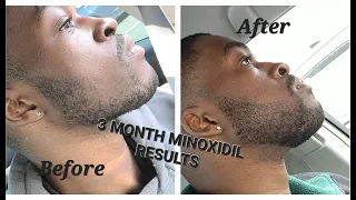 3 MONTH MINOXIDIL BEARD GROWTH RESULTS (TIPS AND TRICKS TO SPEED UP GROWTH)