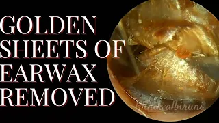 Golden Sheets of Earwax Removed