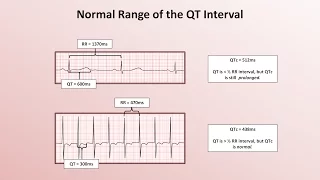 Advanced EKGs - The QT Interval and Long QT Syndrome