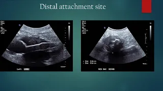 Performing Ultrasound Evaluations on Aorta Endografts (EVAR)