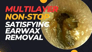Multilayer NON-STOP Satisfying Ear Wax Removal