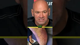 😳🦵 DANA WHITE SHOCKED OVER MAX HOLLOWAY’S LEG AFTER BMF TITLE FIGHT WITH JUSTIN GAETHJE AT UFC 300