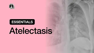 Atelectasis | Chest Radiology Essentials