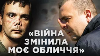 “Я злякався свого відображення”. Історія буковинця Матвійчука, якому заново створюють ніс