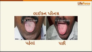 What should you know about Lichen Planus treatment Gujarati - Part 2/2