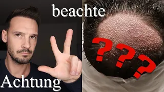 Finger Weg von einer Haartransplantation bei diesen Punkten !