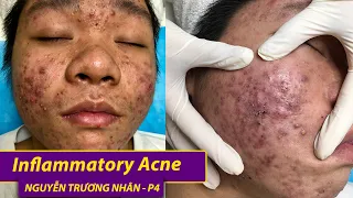 Inflammatory Acen | Điều trị mụn hiệu quả số 1 TPHCM | Hiền Vân spa| Nguyễn Trường Nhân | P4| 534