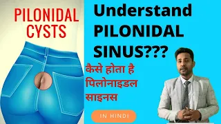 Pilonidal Sinus in Hindi | Pilonidal Sinus Treatment