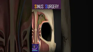 Ballon Sinuplasty, Sinus Surgery #shorts