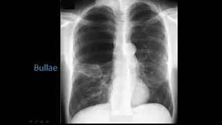 12. Chest Imaging Common Lung Lesions, Dr. Mamdouh Mahfouz