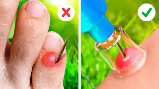 OHHH Splinter! 😬 || Best Hacks That Will Make Your Life Easier in Emergency Situations