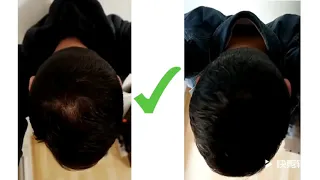 How the Dexe anti hair loss shampoo works？