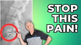 Spondylolisthesis, 3 Best Pain Stoppers & Guide To Pain Free Living