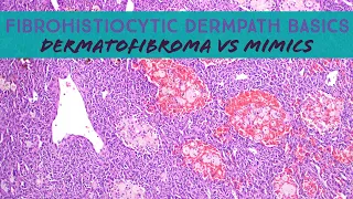 Fibrohistiocytic Dermpath Basics - dermatofibroma & mimics (dermatology dermatopathology pathology)