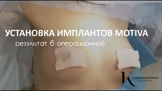 Установка имплантов Motiva - Увеличение груди в клинике Владимира Косинца