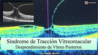 Síndrome de Tracción Vítreomacular. Desprendimiento de Vítreo Posterior.