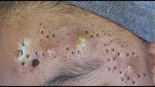 Super squeeze acne asmr Relaxing #17