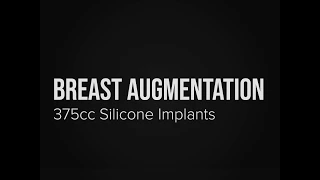 Seattle Breast Augmentation - 375cc Gummy Bear Implants - Before and Afters