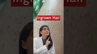 Ingrown Hair Removal | Ingrown Hair | Strawberry Legs #shorts