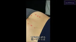 刮痧【Scarping】+针刺【Acupuncture】妇科万能穴 - 八髎【Baliao】的神奇功效！