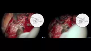 Microsurgical Disconnection of Foramen Magnum dAVF