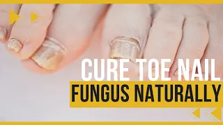 🔴The #1 Best Way To Cure Toenail Fungus.