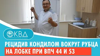 😧 Рецидив кондилом вокруг рубца на лобке при ВПЧ 44 и 53. Клинический случай №493