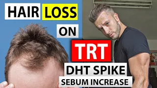 Testosterone and Hair Loss | TRT and DHT spike | Is Big 3 Enough to Save Hair on TRT?