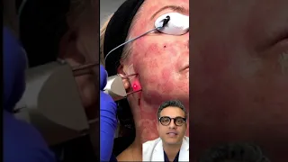 Reno/Tahoe Skin Tightening and Resurfacing Morpheus+CO2 Laser | Avance Plastic Surgery Institute