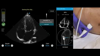 Caption AI Product Demo | AI-Guided Ultrasound System