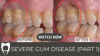 How to treat severe gum disease Part 1 (Treating the right-side of our patients' mouth)